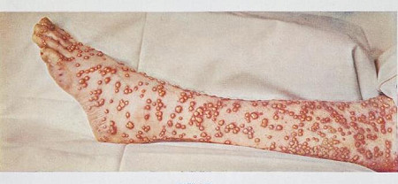 Smallpox pustules.  Photo Wellcome Foundation